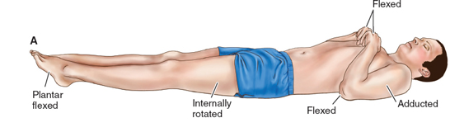 <p><strong>Decorticate posturing</strong> = an abnormal posture associated with severe brain injury, characterized by abnormal flexion of the upper extremities and extension of the lower extremities (flexion and internal rotation of forearms and hands)</p><p>De<strong>cor</strong>ticate = flexion of upper extremities to the <strong>core</strong>—Think “core”; they are protecting their core</p>