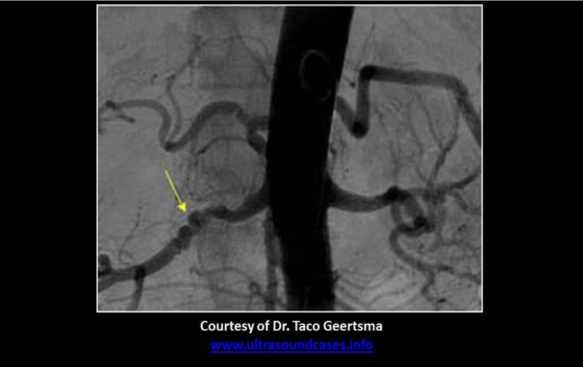 <p>What is the arrow pointing to on the abdominal angiography exam?</p><p>A. fibromuscular dysplasia of the left renal artery</p><p class="p1">B. normal right renal artery</p><p class="p1">C. fibromuscular dysplasia of the right renal artery</p><p class="p1">D. normal tortuous splenic artery</p>