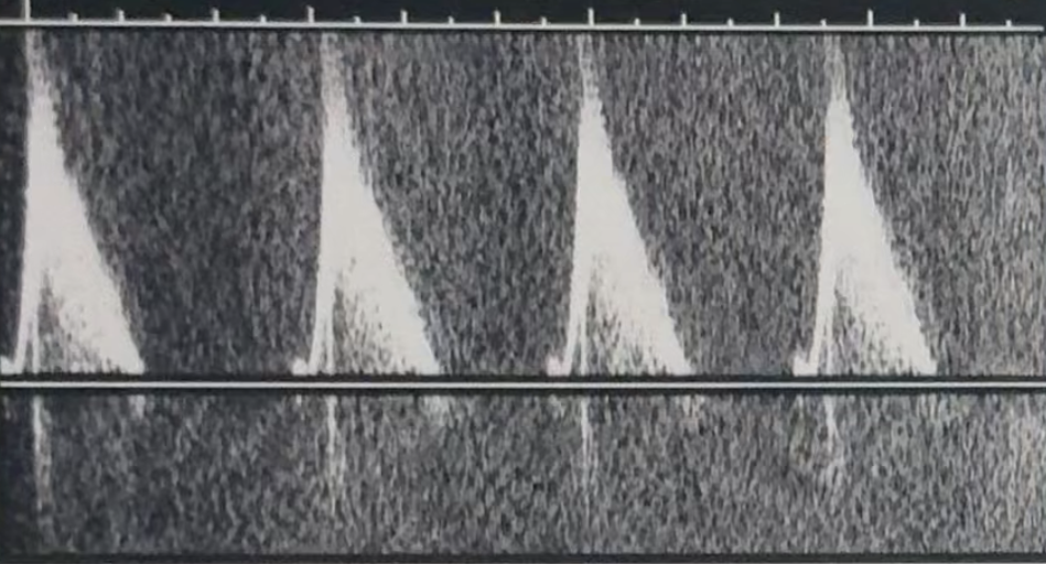 <p>The appearance shown above is most likely caused by:</p>