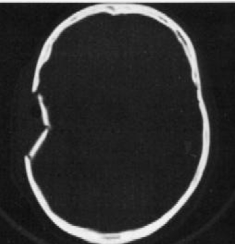 <p>what type of fracture</p>