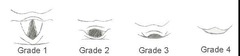 <p>B. Cormack-Lehane</p><p>The answer is B. The Cormack-Lehane scale allows communication of relative ease of visualization of laryngeal structures during laryngoscopy and intubation. The Miller and Macintosh are types of laryngoscope blades, and the LMA (laryngeal mask airway) is a type of airway.</p>