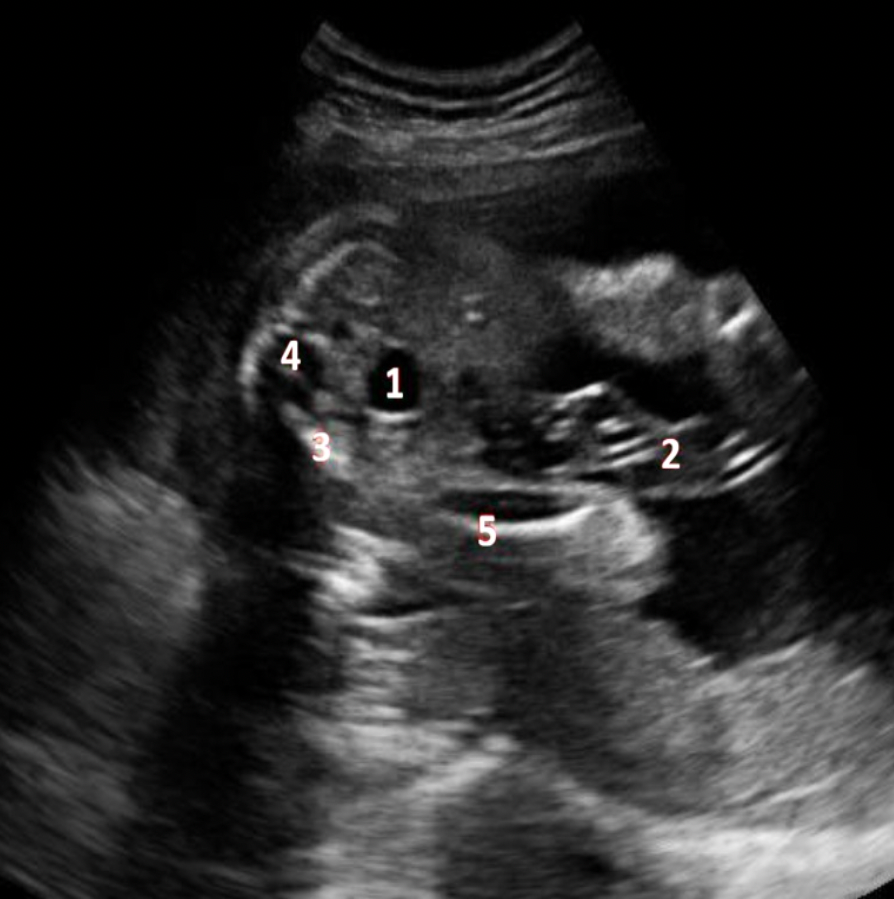 <p>What fetal structure is indicated by #1?</p><p>A. cord</p><p class="p1">B. bladder</p><p class="p1">C. lumbar spine</p><p class="p1">D. sacral spine</p>