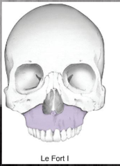 <p>traverse fracture through maxilla above roots of teeth</p><p>symptoms: malocclusion</p>
