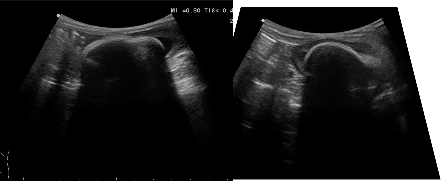<p>what does the following ultrasound show?</p>