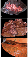 <p>Which disease affecting the renal tubules is shown in the image and occurs in cattle?</p>
