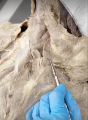 <p>Name the Muscle</p><p>- connected to scapula</p>