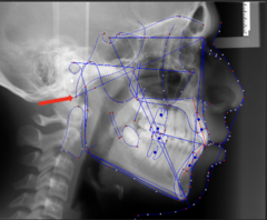 <p>which anatomical landmark:</p><p>- Most inferior posterior point of the occipital bone</p><p>- Also the anterior margin of the foramen magnum</p>
