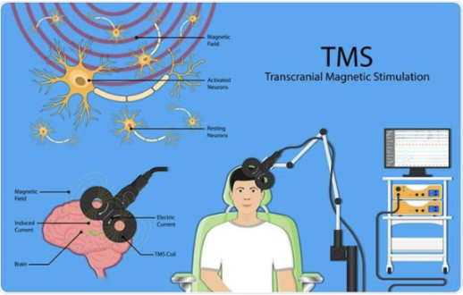 <p>rapidly changing magnetic field indusces an electrical current in the underlying cortex — briefly direxpts normal activity</p><ul><li><p>treatment-resistant OCD and smokingg ccesation, chronic pain, anxiety</p></li><li><p>Limitation: surface cortext only; stimulatig a region also disrupts connections</p></li></ul><p></p>