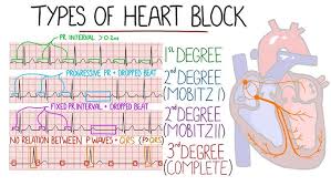 <p>ECG Patterns: AV Blocks</p>