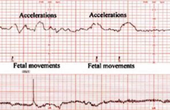 <p>◦Fetal Movement</p><p>◦Healthy Sign</p><p>◦Usually benign</p><p>◦Consider stage of labor</p><p>◦May be sign advanced dilation or beginning of second stage</p>