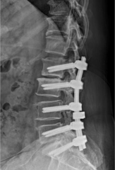 <p>the surgical fixation of two or more spinal elements to create immobile segments to aid bone growth</p>