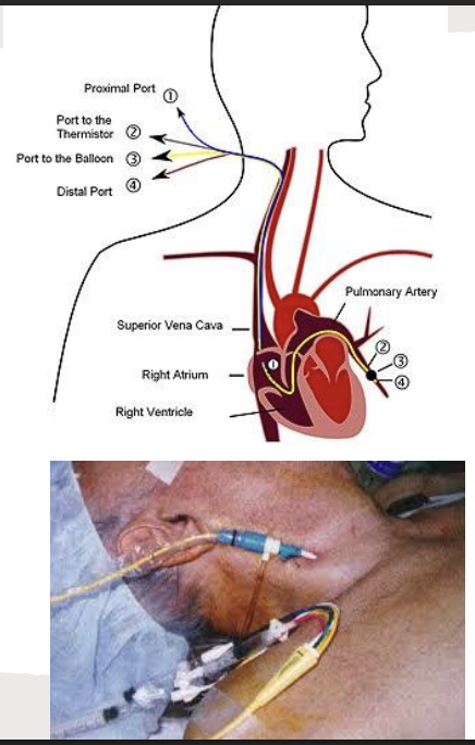 <p>Line</p><p>Purpose: <span style="background-color: transparent;">Used to monitor and measure heart pressures that indicate cardiac function and fluid status (e.g. pulmonary artery pressure); Can also be used for blood draws for venous blood gas</span></p>
