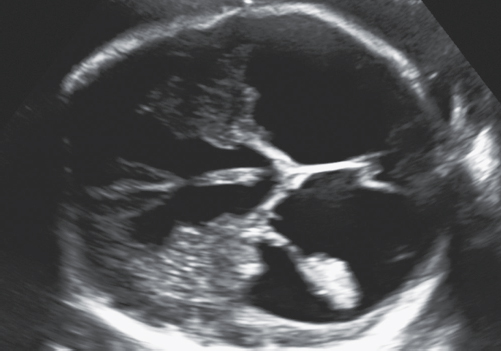 <p>1. The image in Figure 24-31 is indicative of what abnormality?</p><p>Figure 24-31</p><p>a. Ventriculomegaly</p><p>b. Holoprosencephaly</p><p>c. Agenesis of the corpus callosum</p><p>d. Hydranencephaly</p>