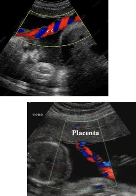 <ul><li><p><span style="color: rgb(255, 115, 115);">2 smaller arteries</span>, <span style="color: rgb(120, 156, 255);">1 large vein</span></p></li><li><p>single umbilical artery (2 vessel cord) is found in 1% of singleton births</p><ul><li><p>can be isolated</p></li><li><p>can be associated with congenital malformation</p></li></ul></li></ul><p></p><p>** umbilical arteries and vein functions opposite from typical a. and v.</p>