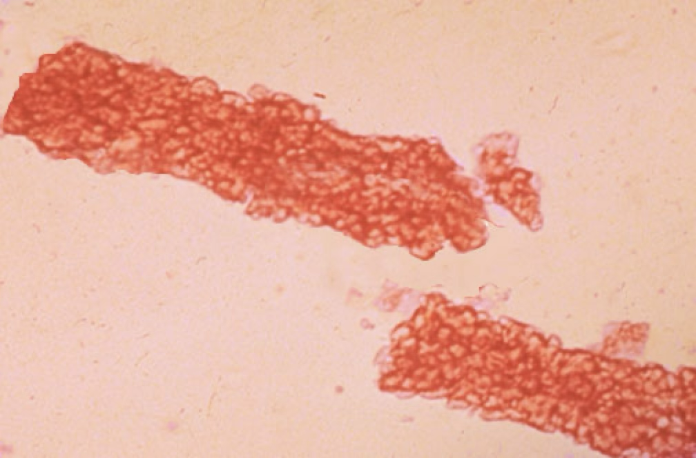 <ul><li><p>Form when RBC’s aggregate/clump within the lumen of the tubule.</p></li><li><p>Presence indicates renal bleeding.</p></li></ul><p></p>