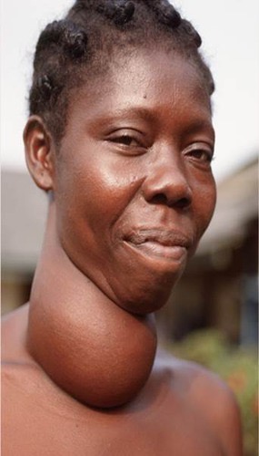 <p><span>goiter</span></p>