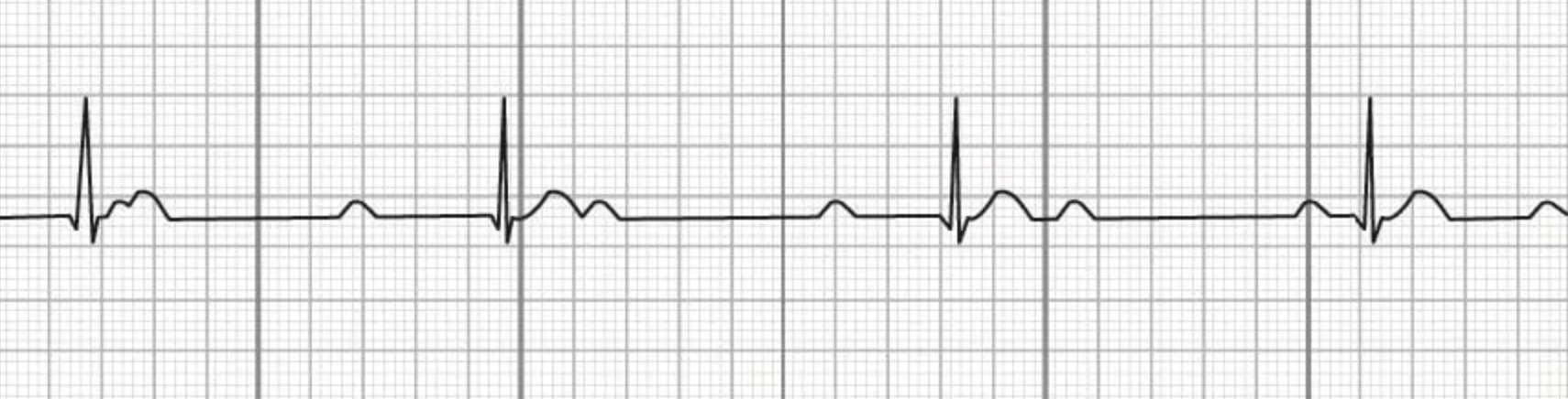 <p>the image shown depicts what cardiac arrhythmia?</p>