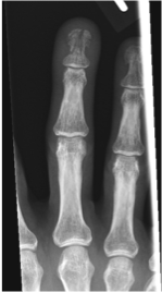 <p>What fracture does the image show?</p>