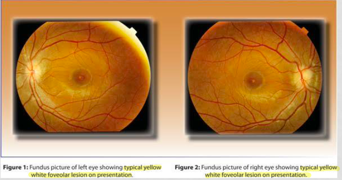 <p>40 y/o caucasian male works as pilot; decreased vision OU</p><p>progressive for last 3m; constant and occasional itching </p><p>Hx: LEE 1 year ago, nasal allergies, uses lubricants and Patanol when needed, allergies to pollen </p><p>FHx: HTN with mother and father </p><p>BCVA: 20/70 OU with +0.25D </p><p>confrontation fields: FTFC; central scotoma on facial Amsler </p><p>CV: mild B/Y defect</p><p>SLE: trace hyperemia, papillae +1; every thing else normal </p><p>fundus: yellow/white foceal lesions with dark around it </p>