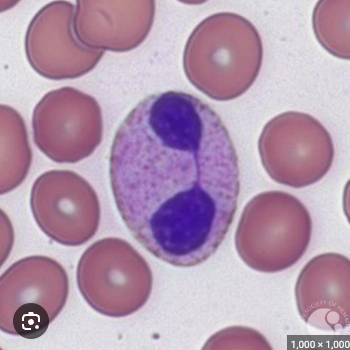 <ul><li><p>1to 2 lobed nuclei, failure of neutrophils to segment</p></li></ul><p></p>