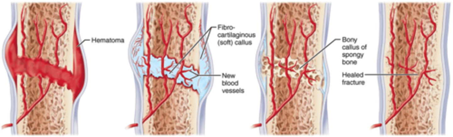 <p>1. blood clot (hematoma) forms at the fracture </p><p>2. fibrocartilaginous callus forms - fibroblasts secrete collagen matrix, osteoblasts begin forming spongy bone</p><p>3. bony callus forms - spongy bone replaces fibrocartilaginous callus</p><p>4. bone remodeling occurs - compact bone reconstructs diaphysis walls</p>