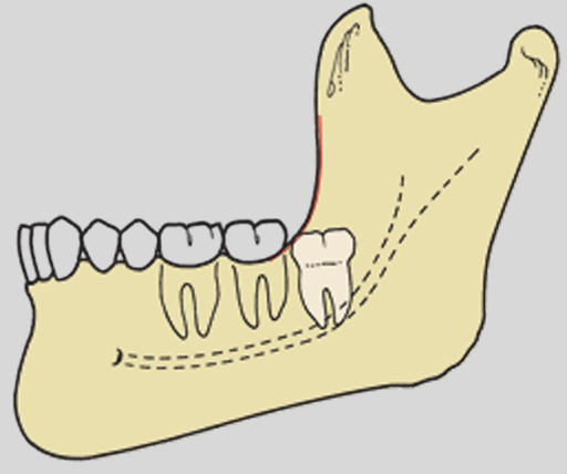 <p>How would you classify this impacted mandibular third molar?</p><p>A) Horizontal, Class 2, B</p><p>B) Mesial angular, Class 1, C </p><p>C) Vertical, Class 3, B</p><p>D) Vertical, Class 1, C</p>