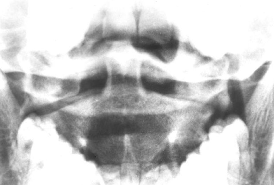 <p>What is the finding and dx of this image</p>