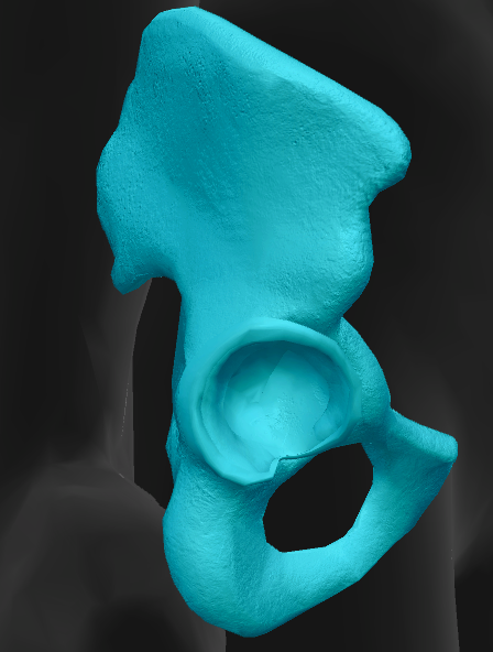<p>superior of obturator foramen</p>