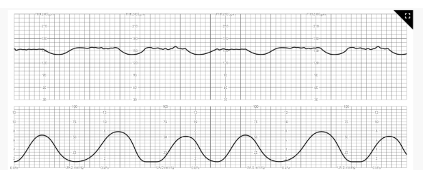 <p><mark data-color="#fffbce" style="background-color: rgb(255, 251, 206); color: inherit;">Nurse Interventions</mark></p><p>A nurse notices the FHR strip. What should the nurse do first</p>