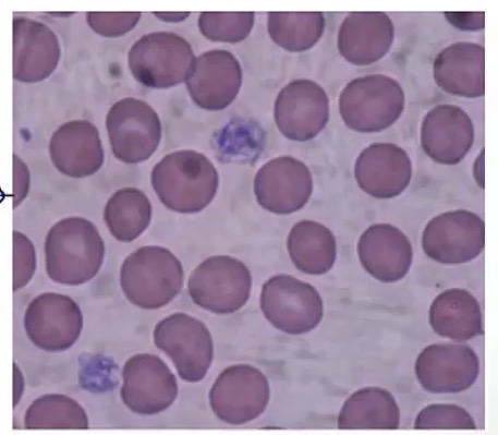<p>-a platelet bleeding disorder</p><p>-G1b</p><p>-platelets can’t bind to vWF, and therefore, can’t bind to the endothelium; you will also see large platelets and thrombocytopenia</p>