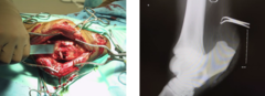 <p>What is the prognosis for septic calcaneal bursitis?</p>