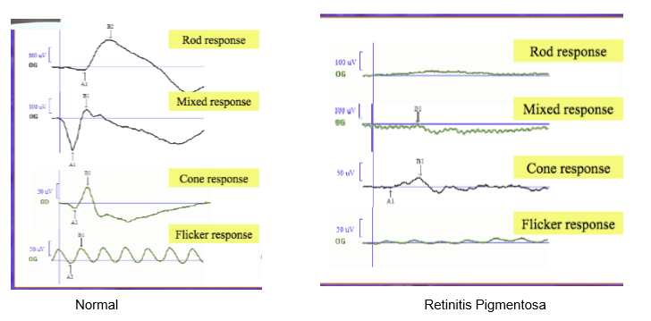 <p>Both cone and rod neurotransmission are severely affected. </p>
