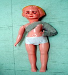 <p><span>fracture of the upper portion of the humerus and shoulder joint with open wound swelling</span></p><p><span>and infection</span></p>