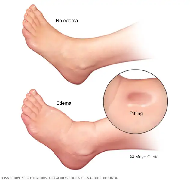 <p>It leads to an oedema</p>