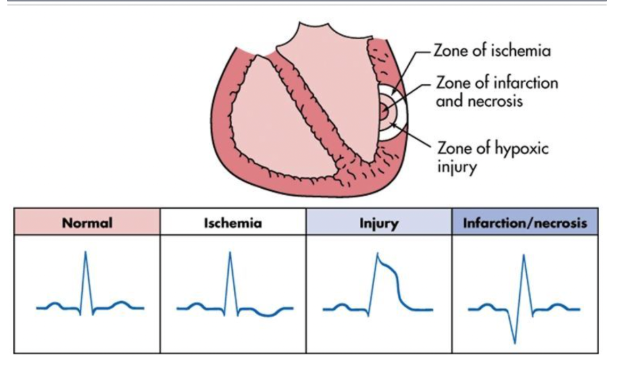 <ul><li><p><span style="background-color: transparent;">Ischemia and non stemi: flipped or inverted T wave&nbsp;</span></p></li><li><p><span style="background-color: transparent;">Transmural MI: elevated ST segment&nbsp;</span></p></li><li><p><span style="background-color: transparent;">Infarction: pathological Q wave</span></p></li></ul><p></p>