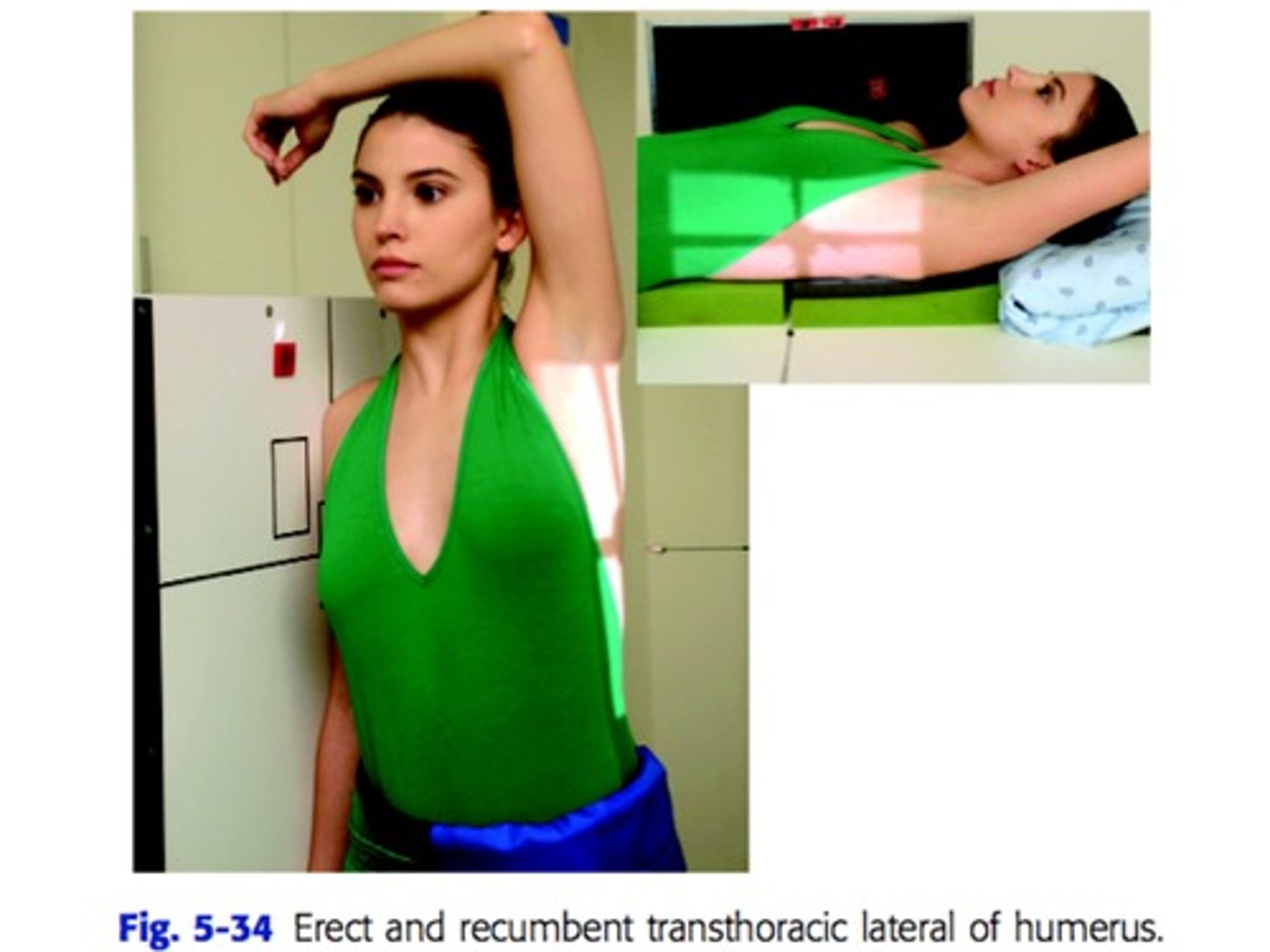<p>S - around waist</p><p>T - 40 mAs @ 75 kVp (decrease mA, increase seconds)</p><p>A - none</p><p>M - injured arm</p><p>P - injured arm touching IR, other arm over the head, CR mid humerus</p><p>S - 40"</p><p>B - orthostatic</p><p>C - 14 by 17, L</p>
