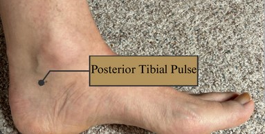 <p>inner ankle, below the ankle bone</p>