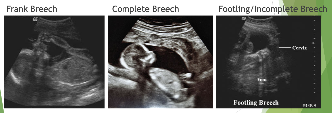 <p>breech lie types</p>