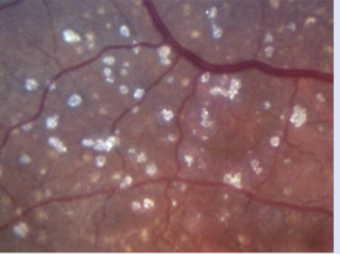 <ul><li><p>Considered end-stage drusen, since all drusen likely contain calcium</p></li><li><p>Strongly associated w/ advanced AMD</p></li></ul><p></p>