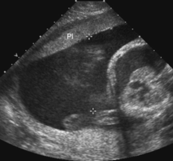<ul><li><p>infection</p></li><li><p>intrauterine growth restriction (IUGR)</p></li><li><p>aneuploidy (chromosomal abnormality)</p></li></ul><p></p>