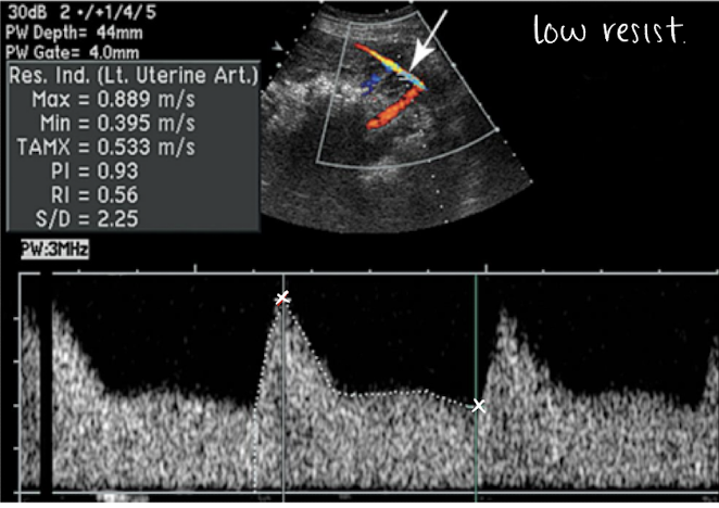 <p>uterine artery PW (varies based on trimester):</p><ul><li><p>high RI flow pattern in 1st trimester</p></li><li><p>low RI flow pattern in 2nd trimester</p><ul><li><p>lots of blood flow going through uterine artery to get to placenta and supply baby with oxygen</p></li></ul></li></ul><p>SONO evaluation:</p><ul><li><p>use optimal gate, gain, scale, placement</p></li><li><p>measure waveform and RI </p></li></ul><p></p>