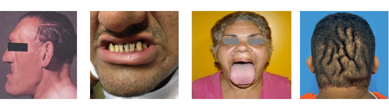 <ul><li><p>GH excess<strong> after closure of epiphyseal plates</strong></p></li><li><p>enlargement of hands, feet, and facial bones</p></li><li><p>mandibular prognathism with coarse features</p></li><li><p>macroglossia with spacing of normal teeth</p></li><li><p>associated systemic disease risk increased </p></li></ul><p></p>