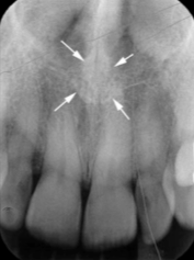<p>nasal spine</p>