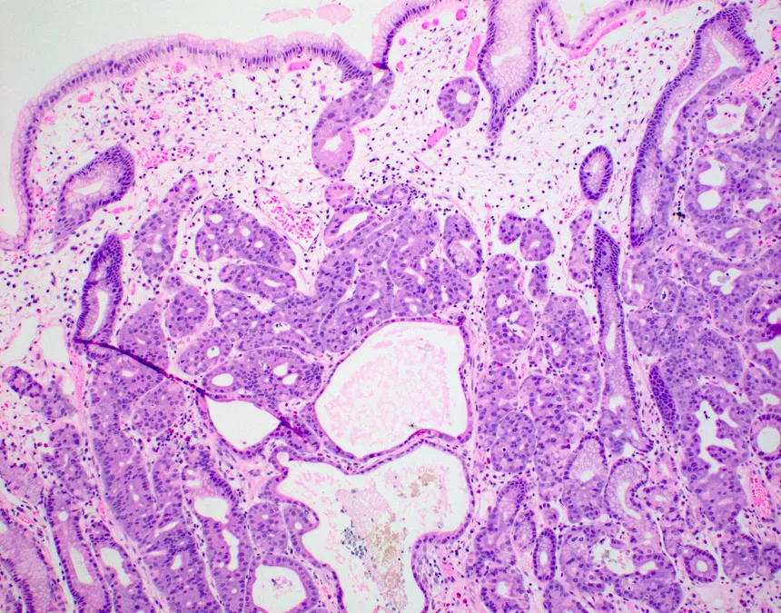 <p>Polype de l’estomac </p><p>1) diagnostic</p><p>2) histo</p><p>3) risque </p><p>4) dd si invasion dans la sous-muqueuse </p>