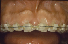 <p>Your patient present like this clinically, but radiographically the crowns look much longer. What is the diagnosis?</p>