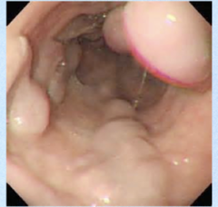 <p>This esophagoscope shows what disease?</p>