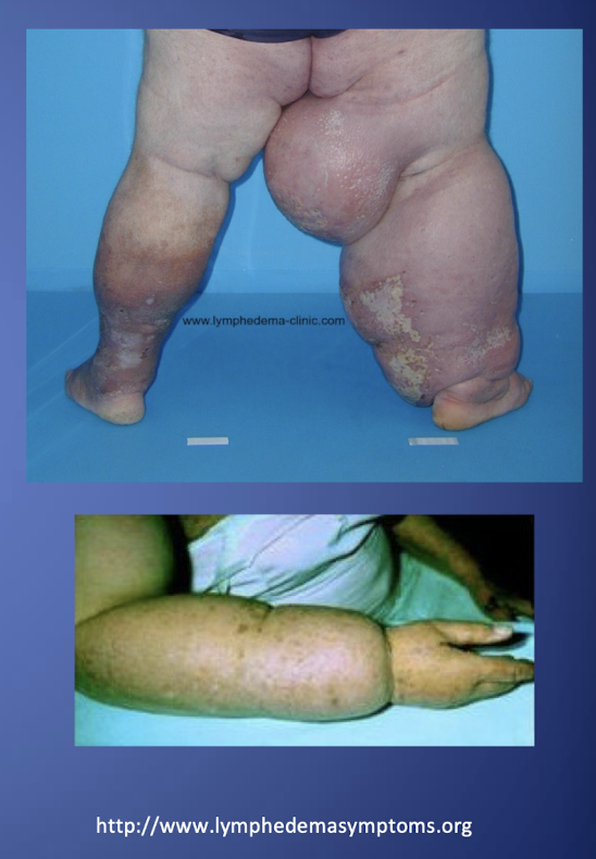 <p>-Chronic debilitating disease </p><p>-Requires lifelong management </p><p>-If untreated can progress causing:</p><ul><li><p>Continued proliferation of fibrotic tissue </p></li><li><p>increase in size of infected limb</p></li><li><p>chronic infections</p></li></ul><p>-Results in an increase in functional impairment and a decrease in quality of life </p>
