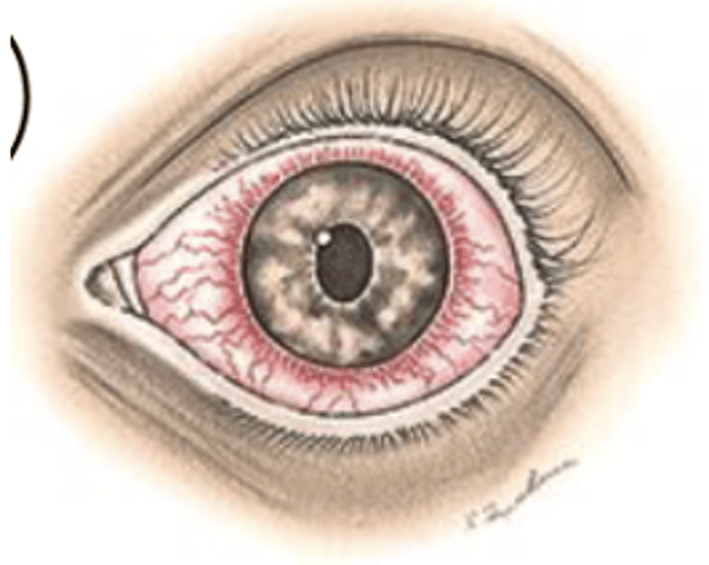 <p>Diffuse redness, often with a steamy cornea and marked circumcorneal flush.</p><p>Pain: Severe, aching, deep, severe photophobia</p><p>Decreased vision</p><p>Pupils dilated and fixed</p><p>Cornea Steamy, cloudy</p><p>Significance: EMERGENCY Acute increase in intraocular pressure constitutes an emergency (acute close angle glaucoma)</p>