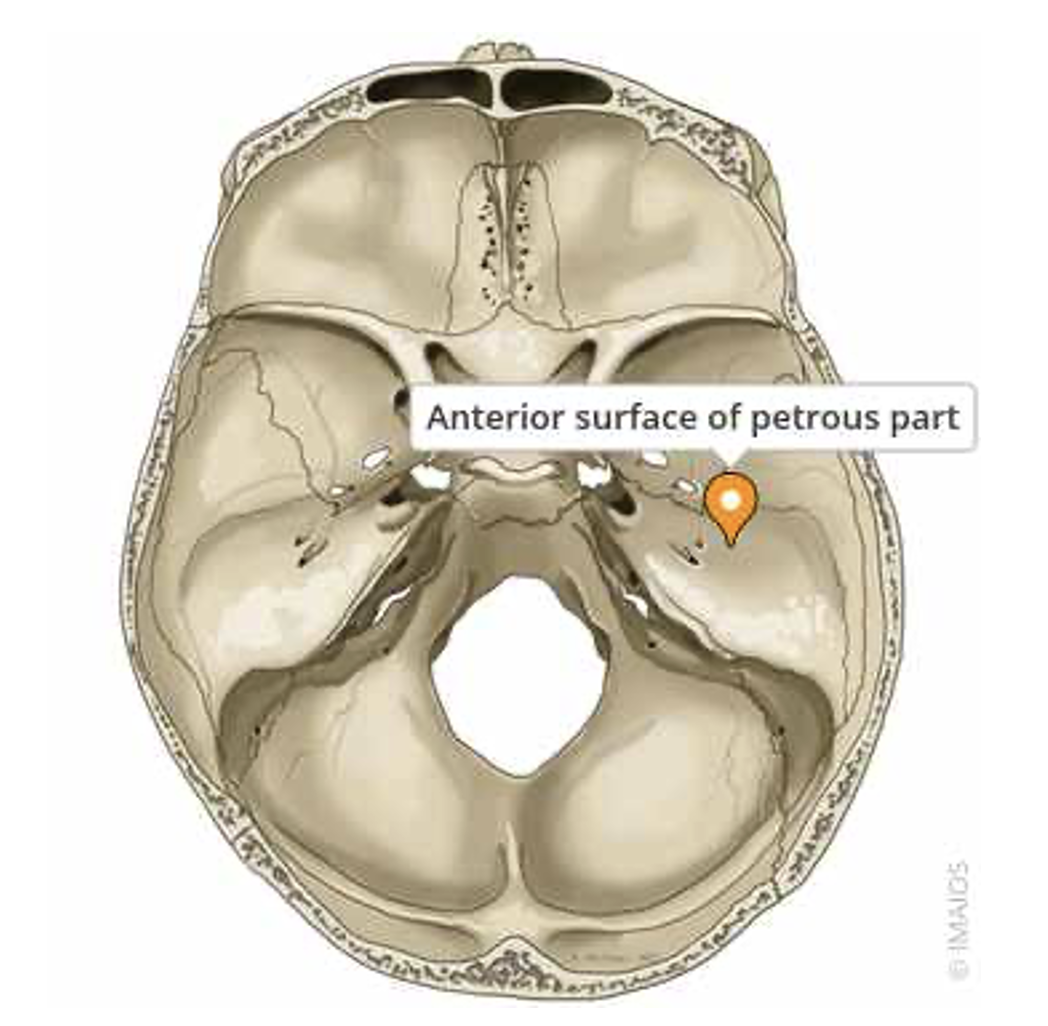<p>Petrous portion of temporal bone</p>