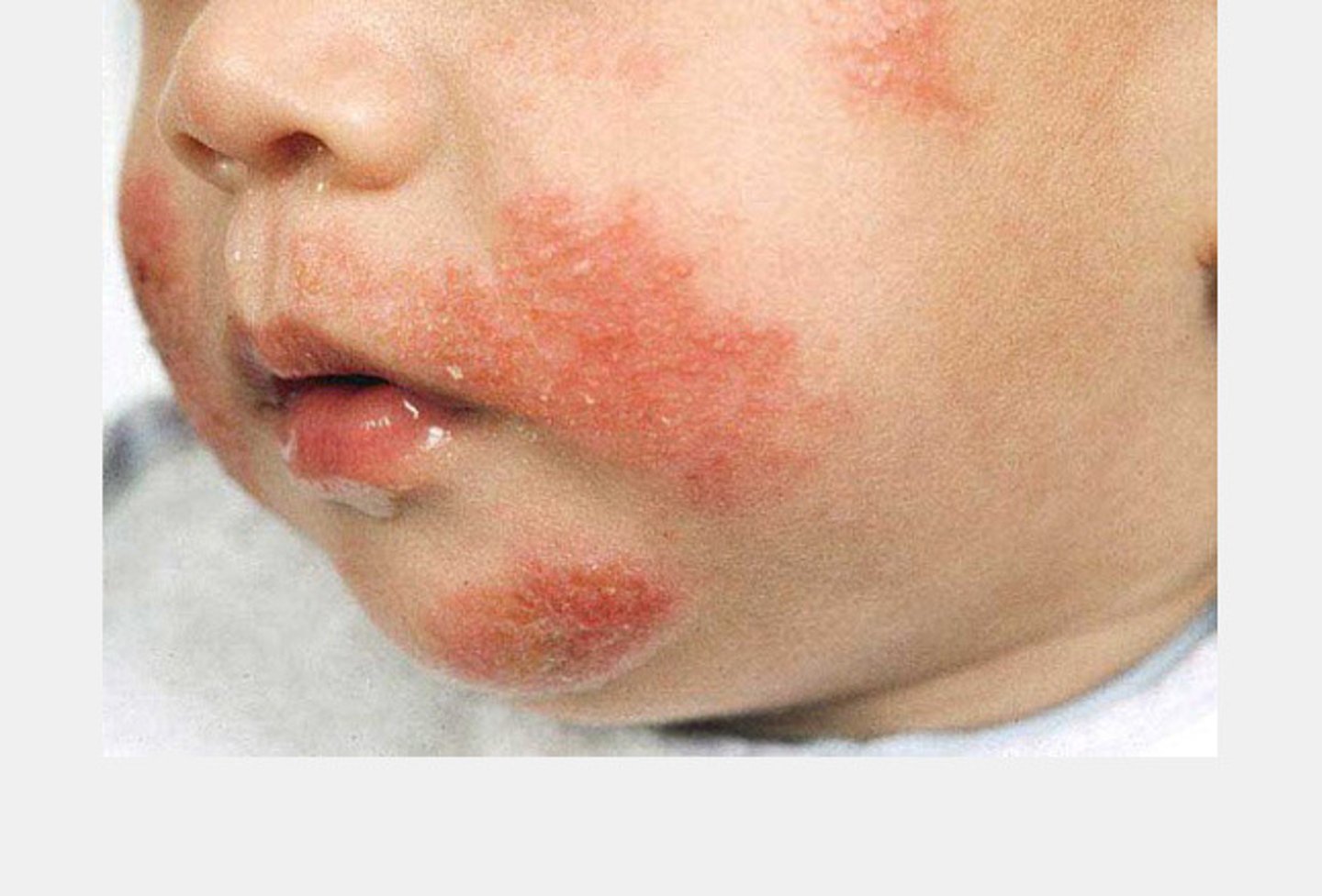 <p>dermatitis</p>